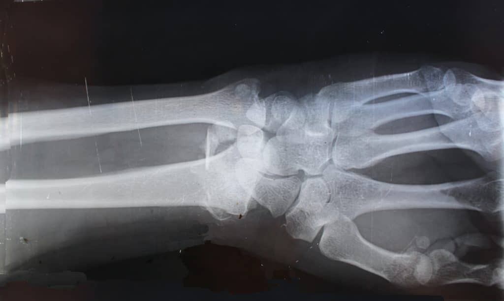 x-ray wrist bones