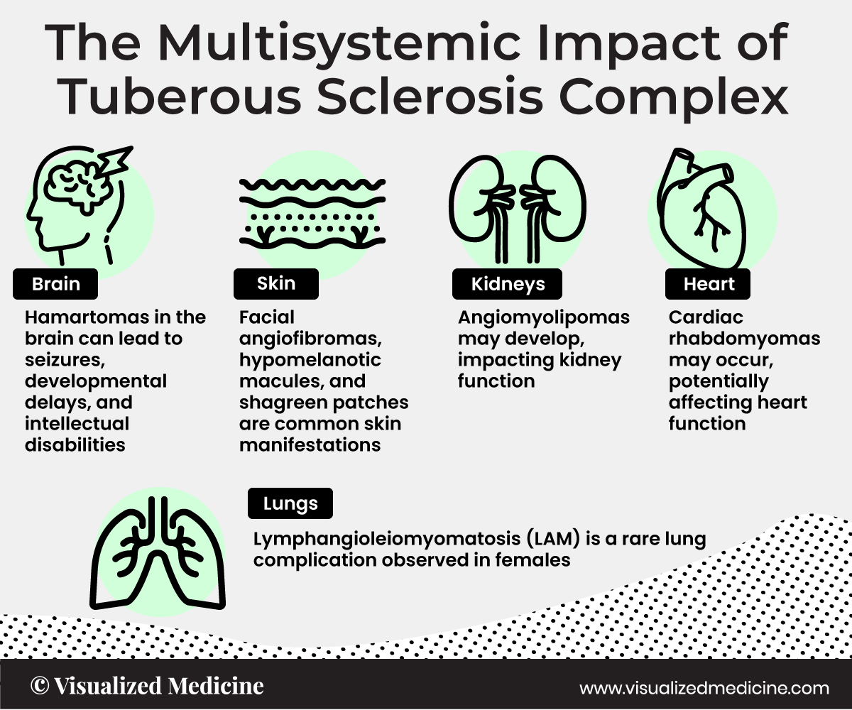 rv-the-impact-of-tuberoussclerosis.png